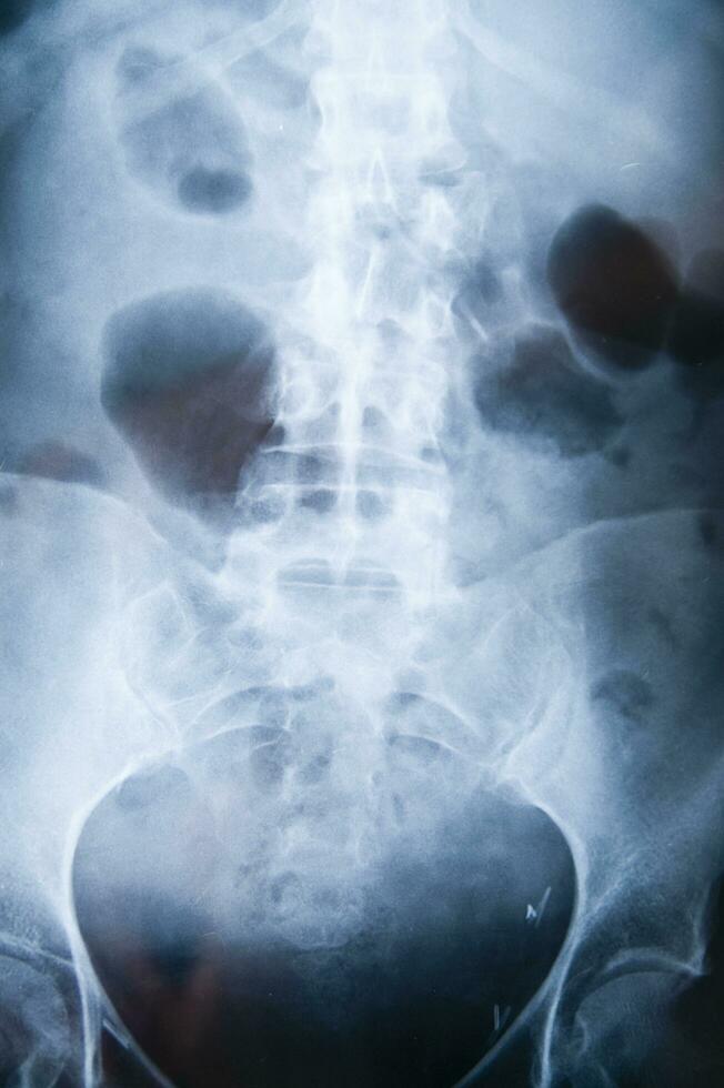 a x - ray image of a person's back photo