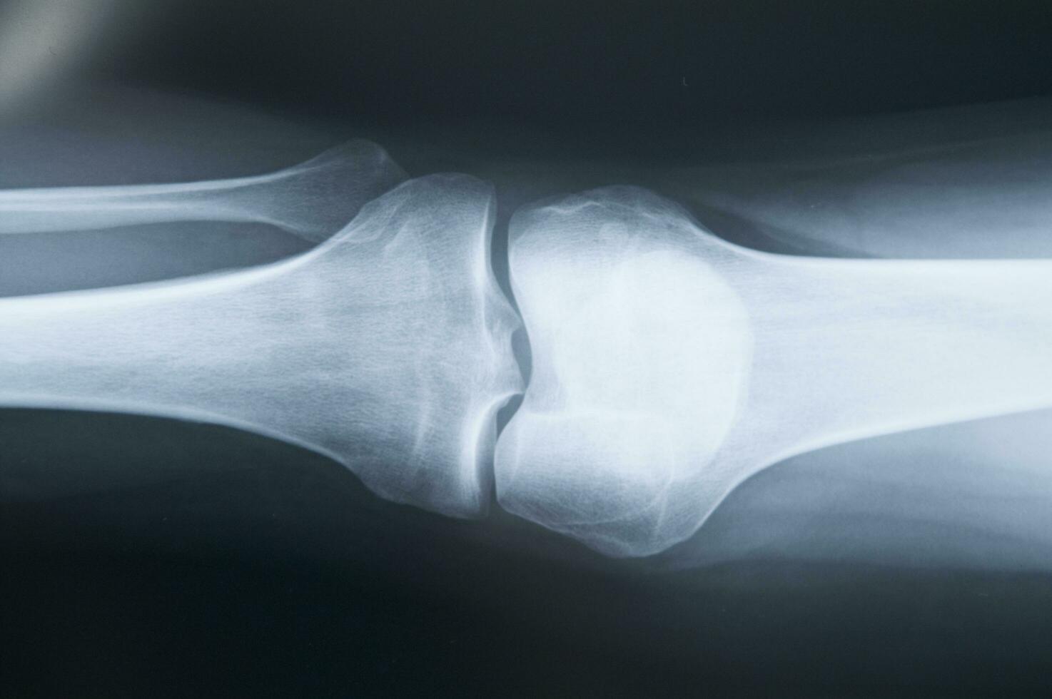 a x - ray image of a person's back photo