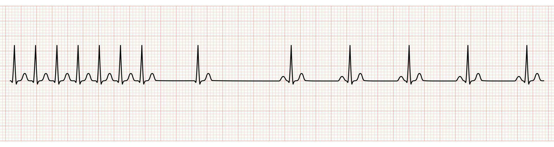 EKG Monitor Showing  Supraventricular Tachycardia Change to Sinus Rhythm After Adenosine Injection vector