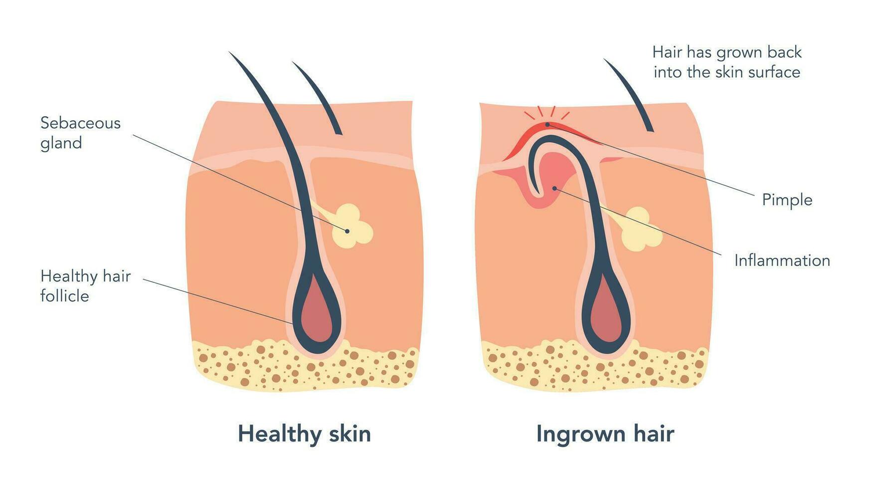 Ingrown hair and normal hair medical schemes under microscope. Ingrown hair leads to the redness and inflammation, that associated also with pimples and blocked pores. Vector illustration