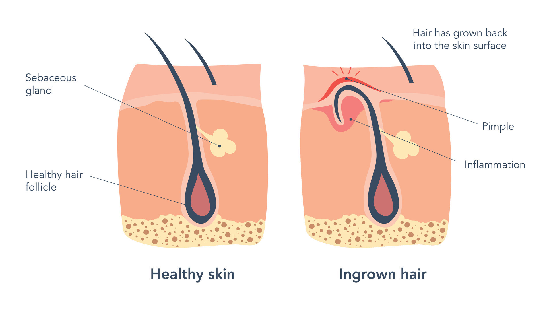 pimple microscope