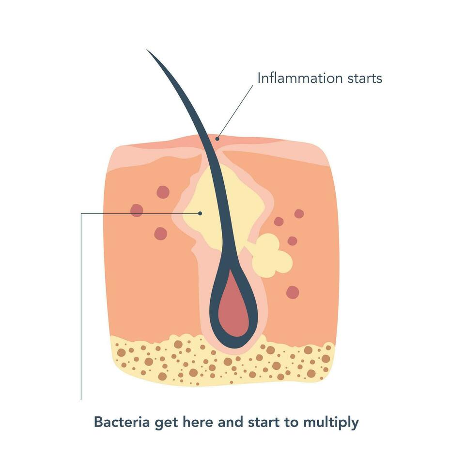 enconado piel alrededor el pelo folículos profundo en el poros segundo etapa de inflamación, dónde bacterias obtener dentro y comienzo a multiplicar sí mismo. vector ilustración