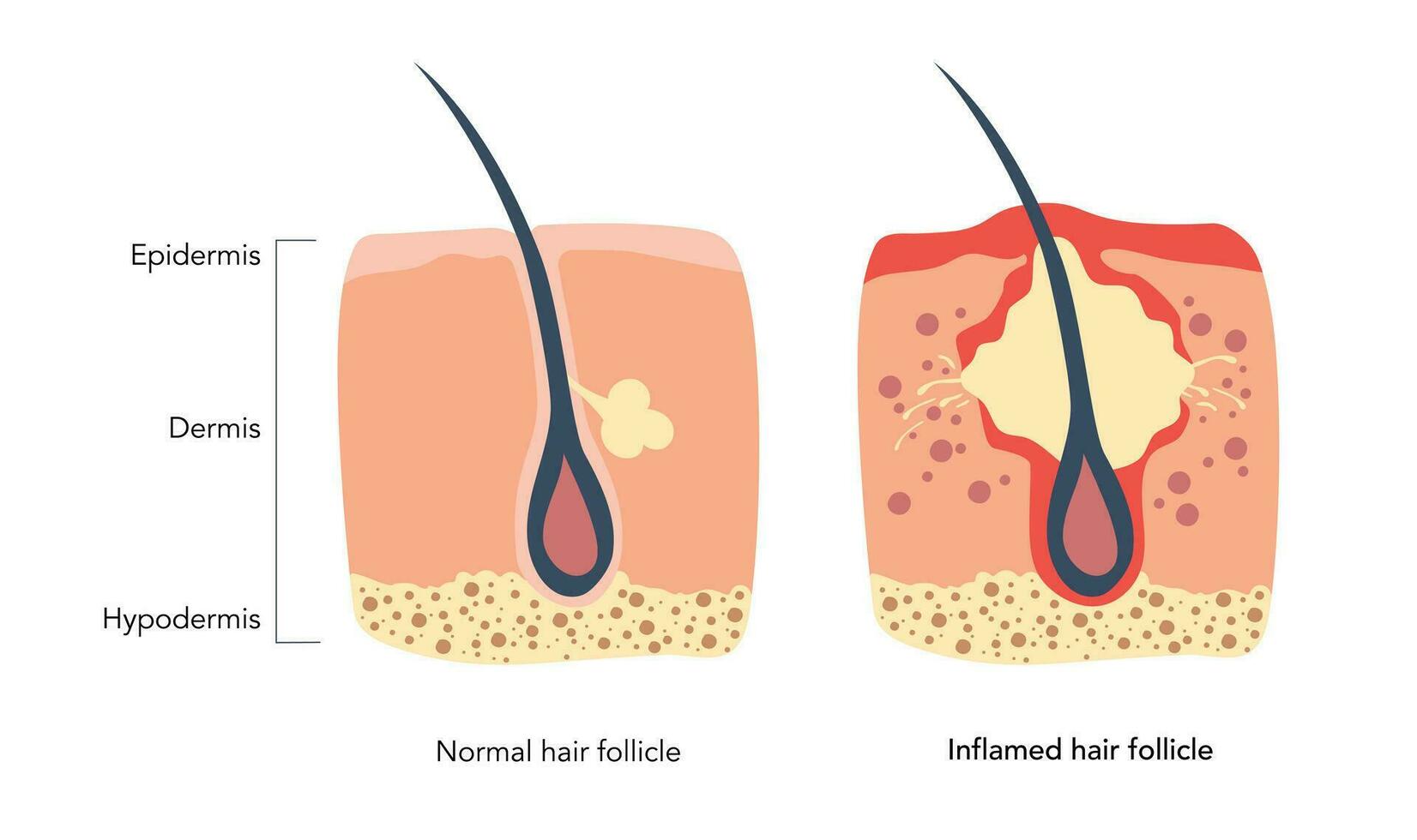 Inflamed follicle and normal healthy hair follicle medical schemes under microscope. Ingrown hair leads to the redness and inflammation, that associated with pimples. Epidermis, Dermis, Hypodermis. vector