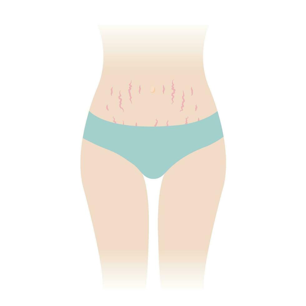 Red stretch marks on tummy vector illustration isolated on white background. The striae rubrae appear on the abdomen, mid stomach, belly front of woman body. Skin care and beauty concept.