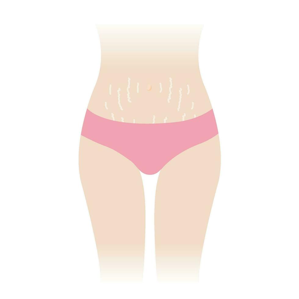 Stretch marks on tummy vector illustration isolated on white background. The white stretch marks appear on the abdomen, mid stomach, belly of woman body. Skin care and beauty concept.