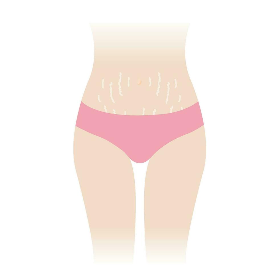 tramo marcas en barriguita vector ilustración aislado en blanco antecedentes. el blanco tramo marcas Aparecer en el abdomen, medio estómago, barriga de mujer cuerpo. piel cuidado y belleza concepto.