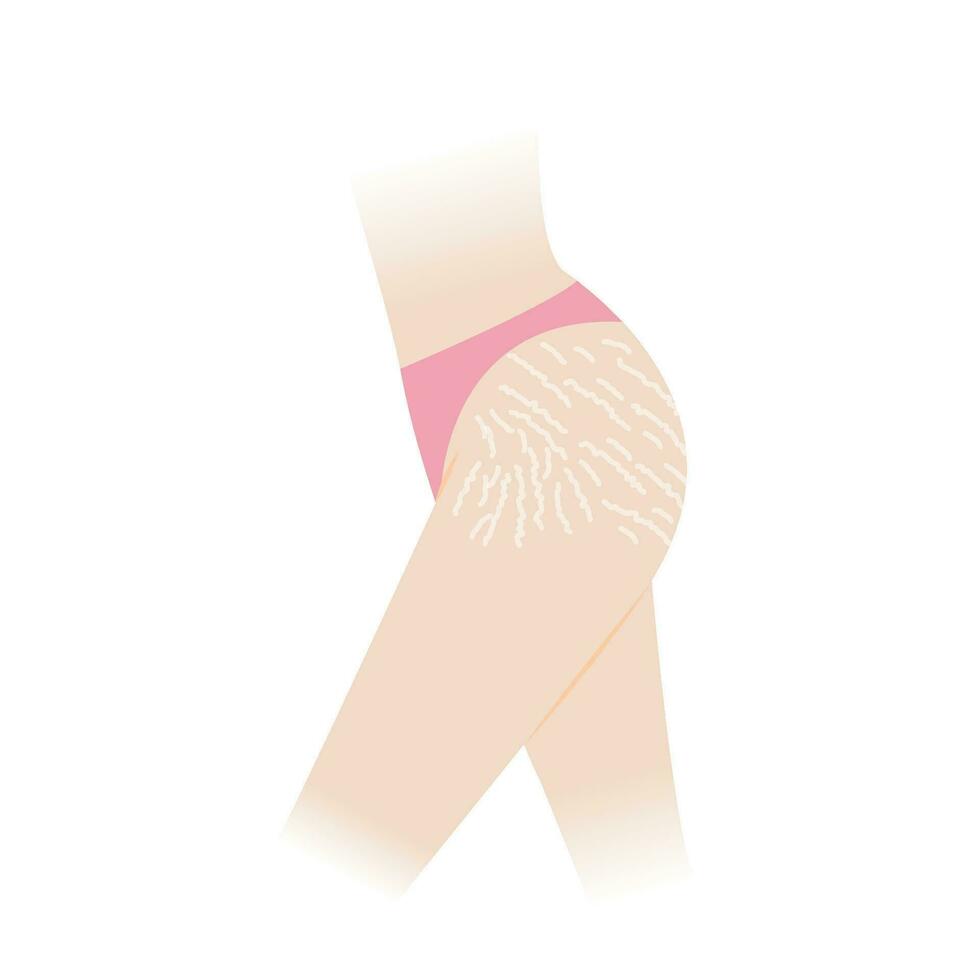 Stretch marks on hip and thigh vector illustration isolated on white background. The white stretch marks, striae albae appear on the hip and thigh side of woman body. Skin care and beauty concept.