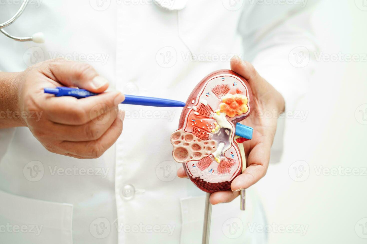 Chronic kidney disease, doctor holding model for treatment urinary system, urology, Estimated glomerular filtration rate eGFR. photo