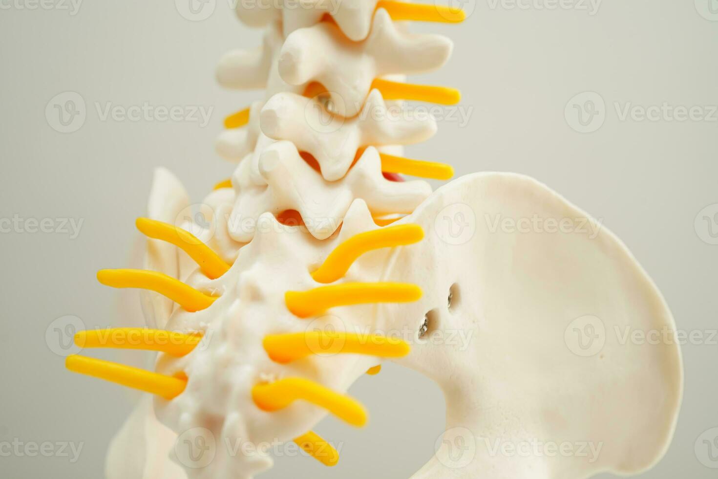 Spinal nerve and bone, Lumbar spine displaced herniated disc fragment, Model for treatment medical in the orthopedic department. photo