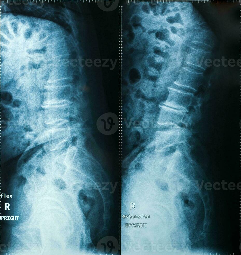 X-Ray image, View of neck men for medical diagnosis. photo