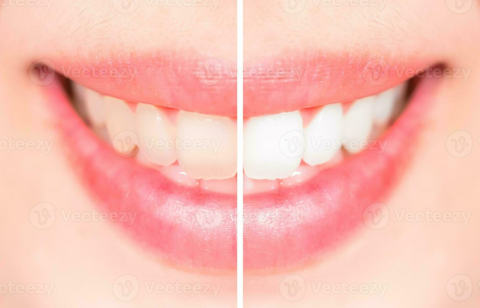 Close-up teeth female between before and after brush the teeth, selective focus photo