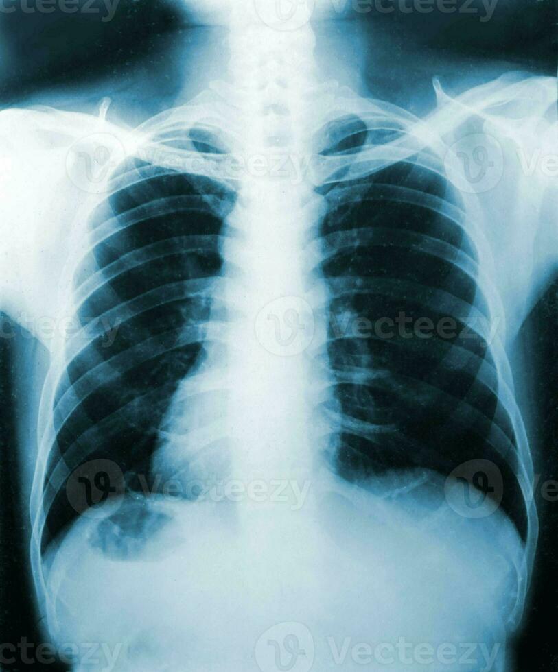 Imagen de rayos X, vista de hombres en el pecho para diagnóstico médico. foto