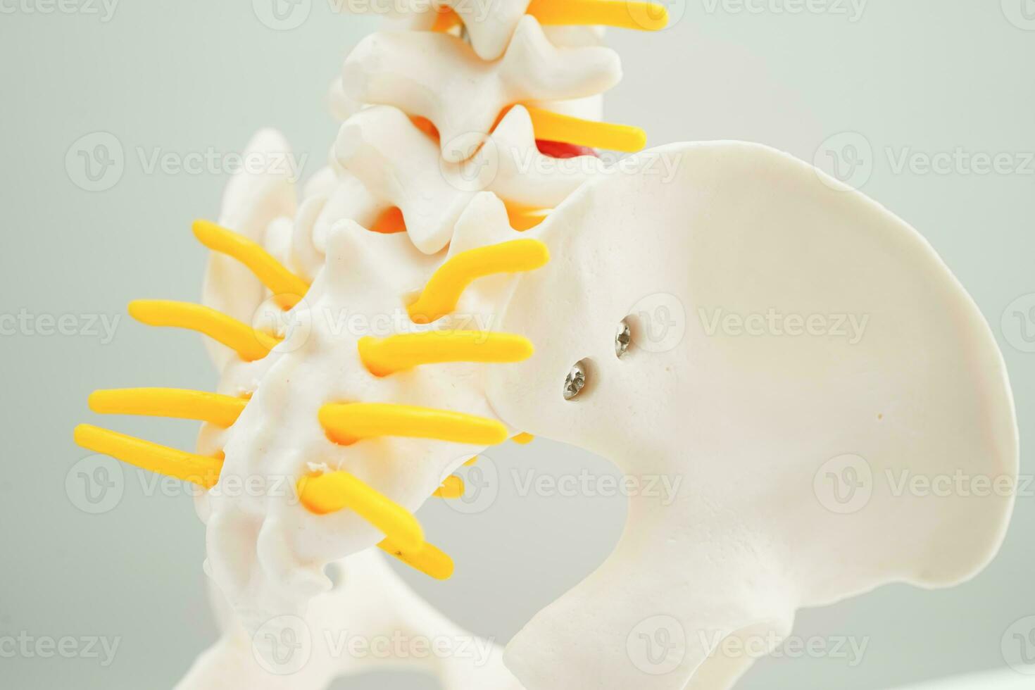Spinal nerve and bone, Lumbar spine displaced herniated disc fragment, Model for treatment medical in the orthopedic department. photo