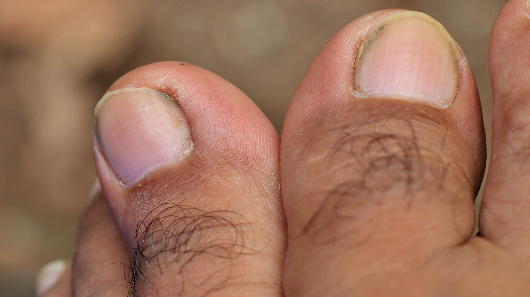 Close up of male foot and dirty long toe nail photo
