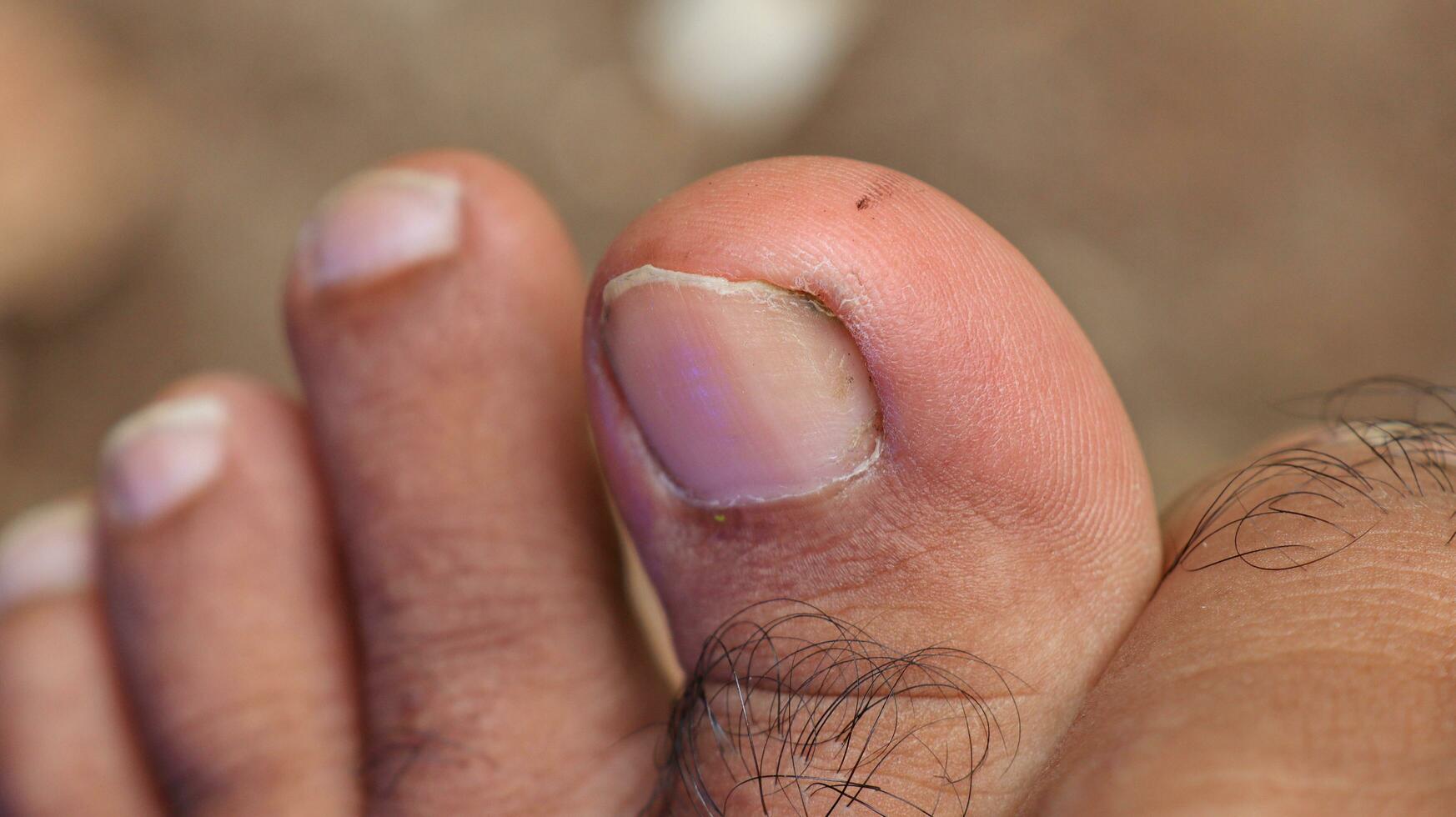 Close up of male foot and dirty long toe nail photo