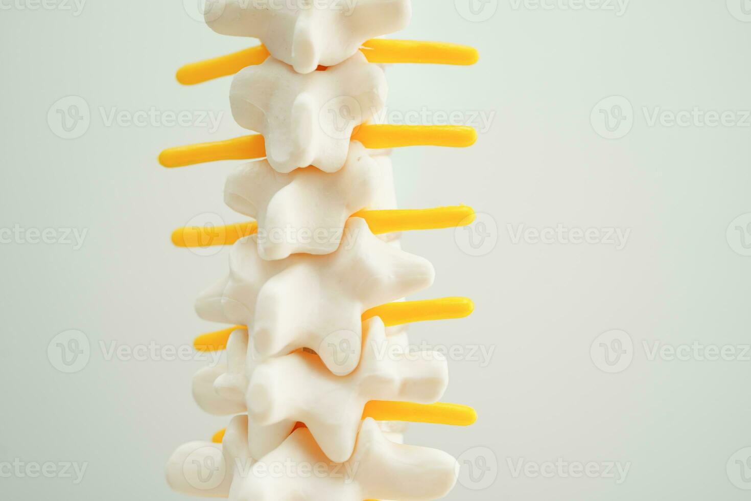 Spinal nerve and bone, Lumbar spine displaced herniated disc fragment, Model for treatment medical in the orthopedic department. photo