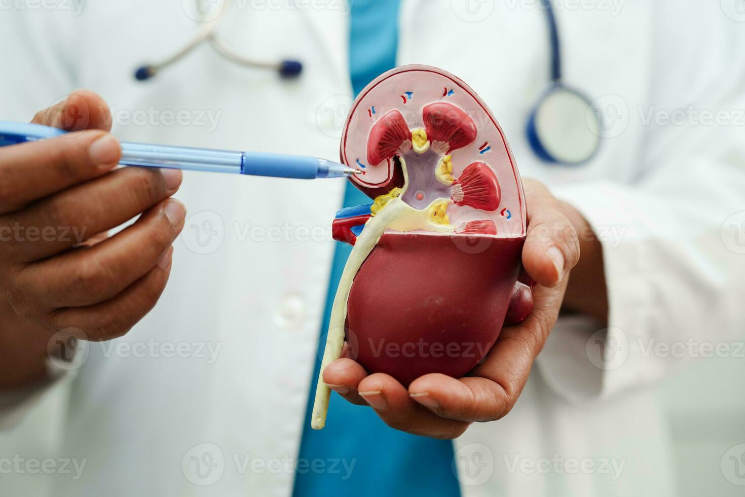 Chronic kidney disease, doctor holding model for treatment urinary