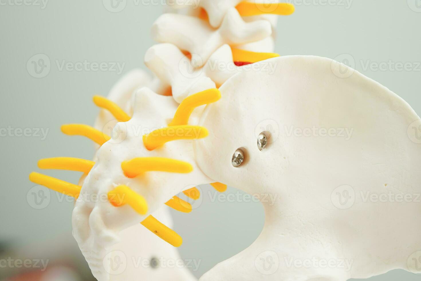 Spinal nerve and bone, Lumbar spine displaced herniated disc fragment, Model for treatment medical in the orthopedic department. photo