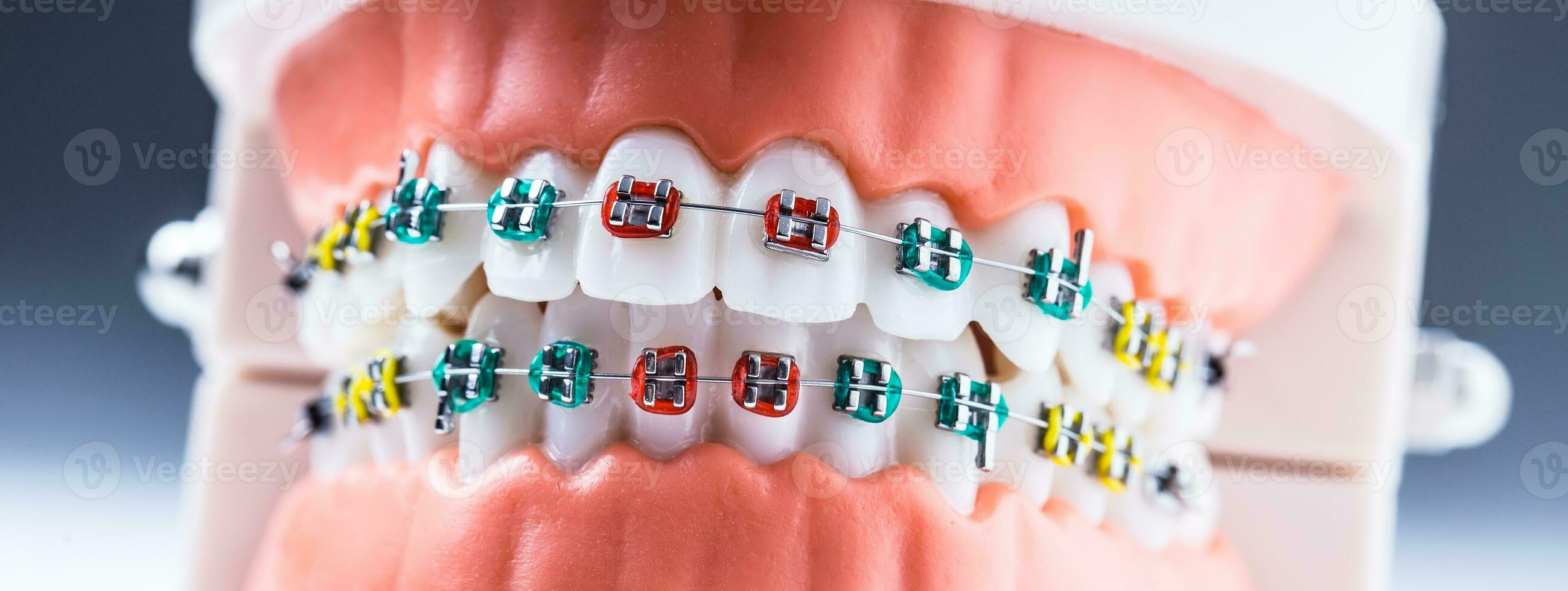 Close-up of a orthodontic model jaws and teeth with braces photo