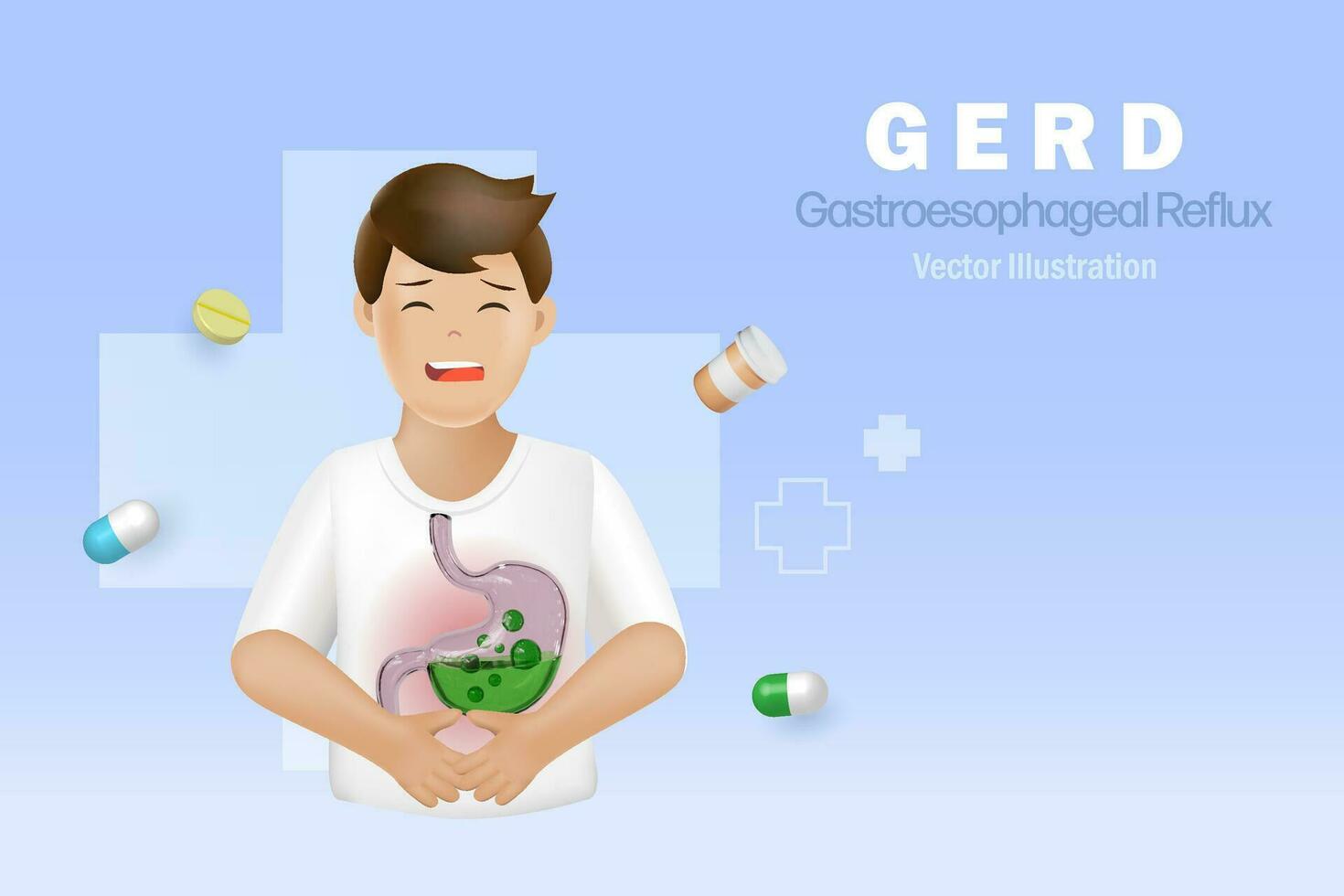 GERD gastroesophageal reflux acid on patient stomach. Digestive disorder causes patient heartburn pain or acid reflux indigestion. Medical and healthcare. 3D vector. vector