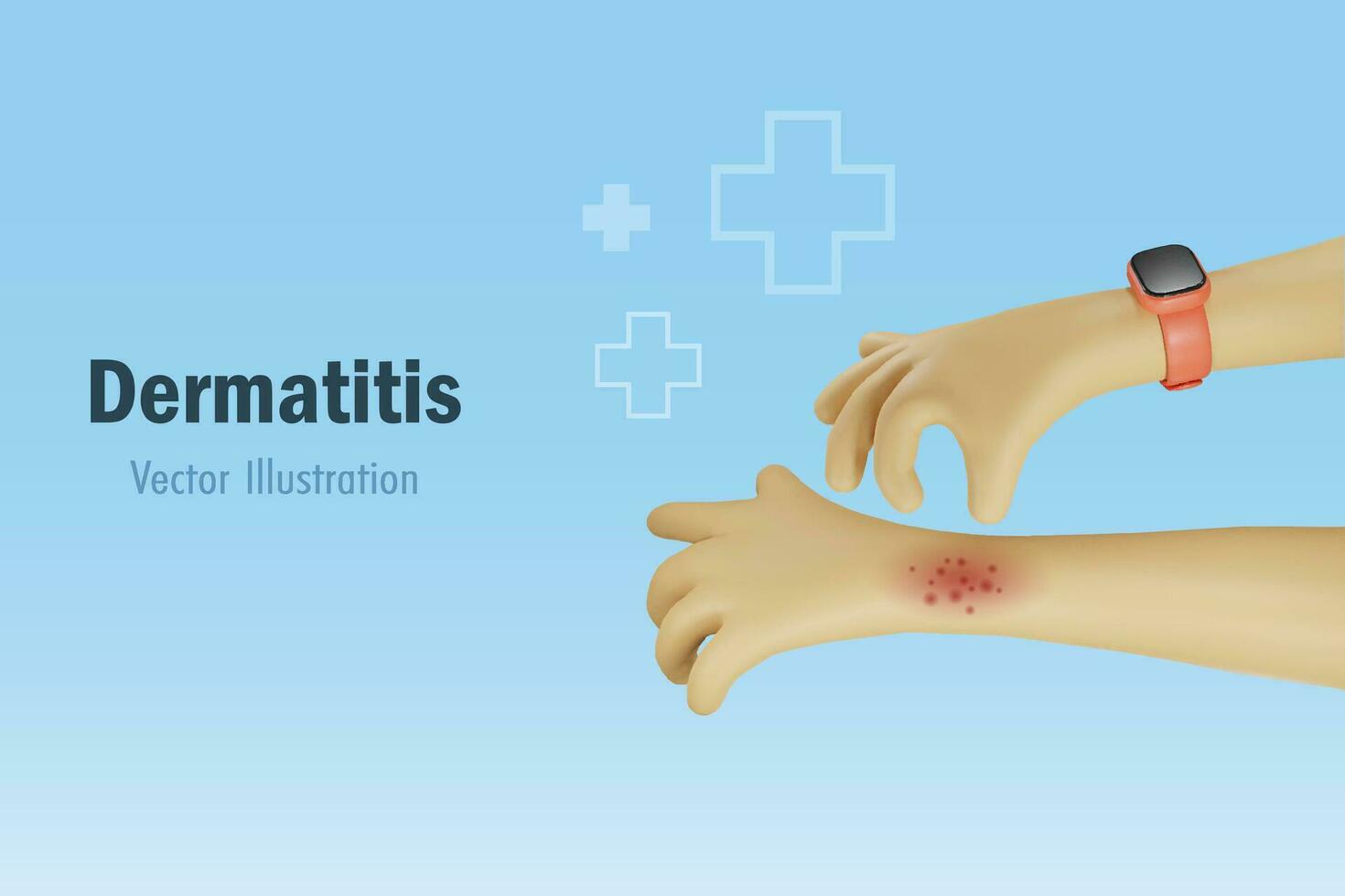 dermatitis, alergia y médico piel problema. mano rascarse en que produce picor brazo. médico y salud cuidado. 3d vector. vector