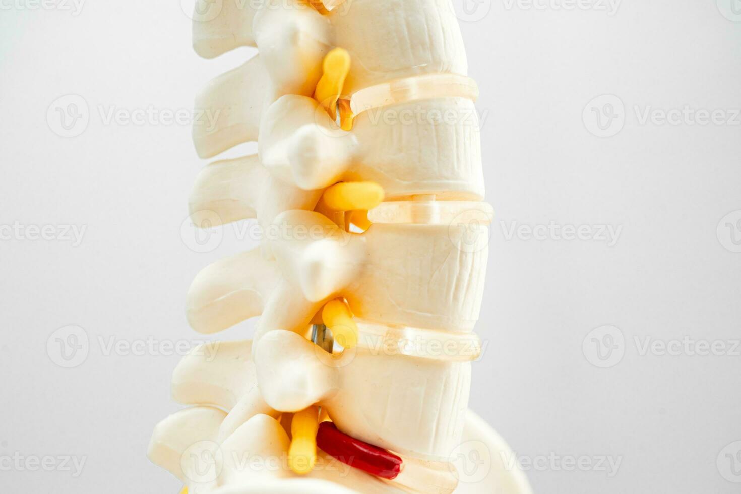 Lumbar spine displaced herniated disc fragment, spinal nerve and bone. Model for treatment medical in the orthopedic department. photo