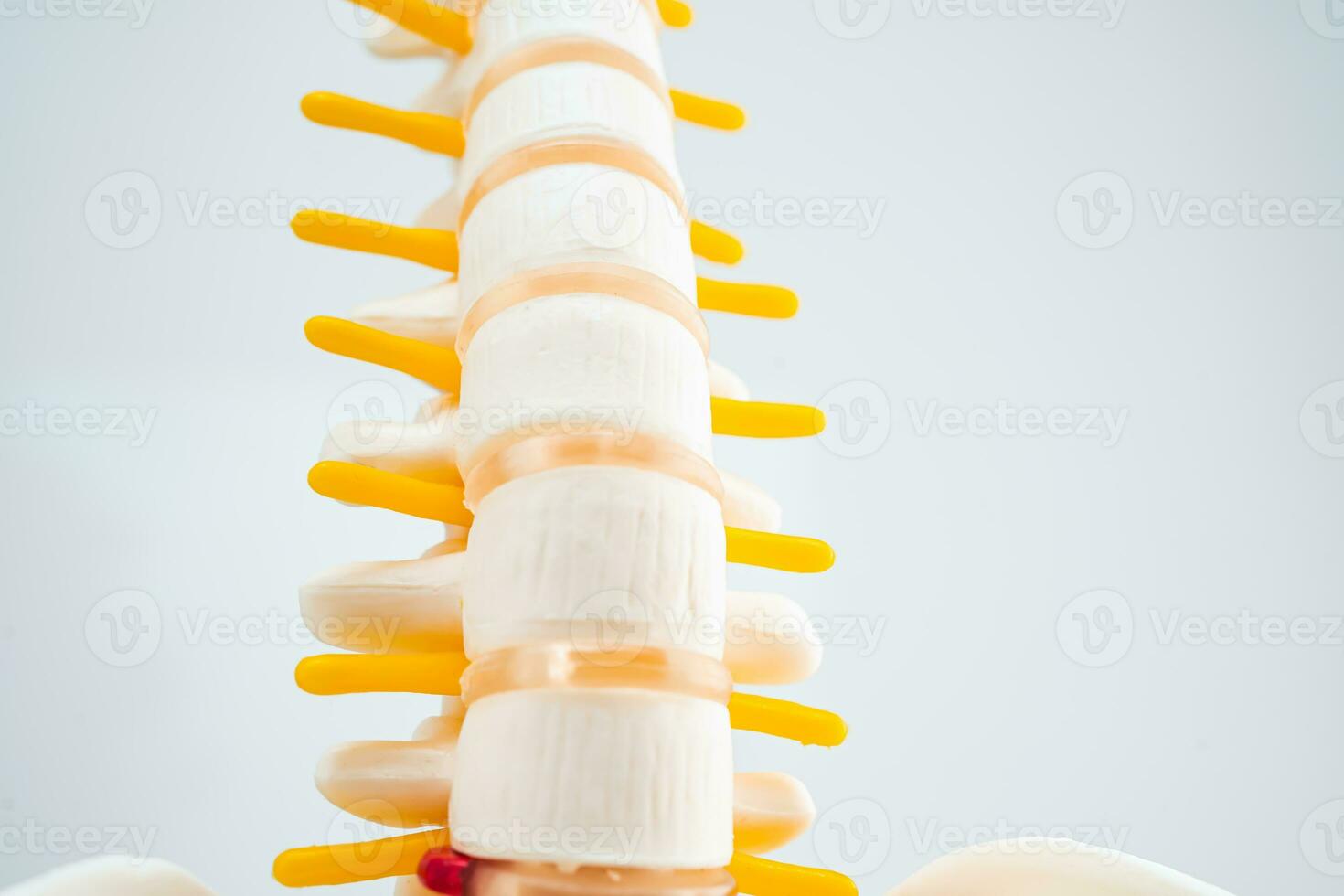 Lumbar spine displaced herniated disc fragment, spinal nerve and bone. Model for treatment medical in the orthopedic department. photo
