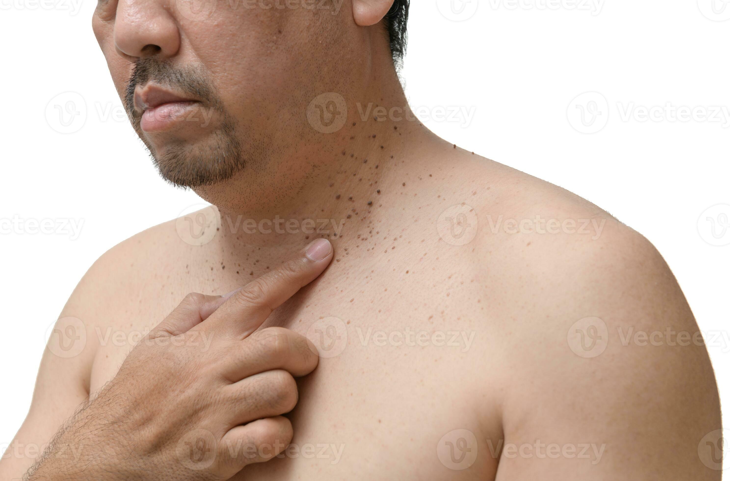 middle age senior man point to skin tags or acrochordon on his