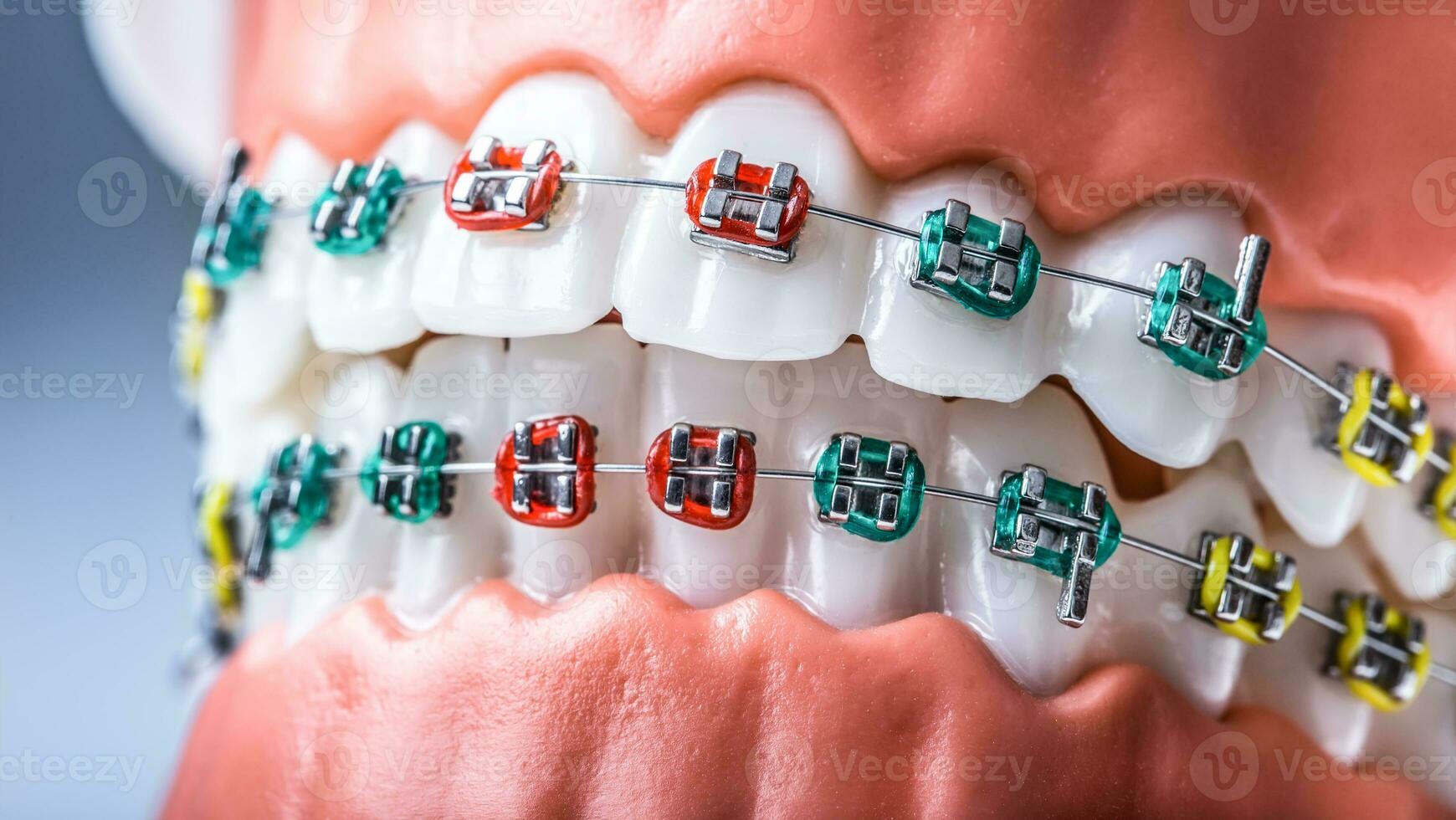 de cerca de un ortodoncia modelo mandíbulas y dientes con tirantes foto