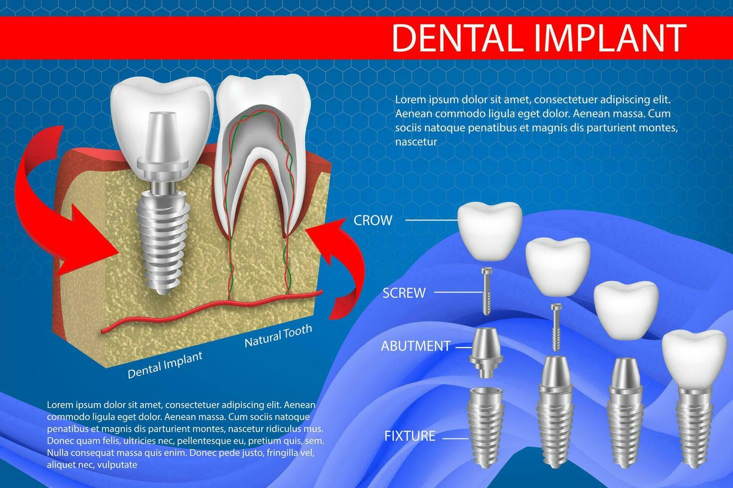 humano dientes y dental implante vector ilustración.