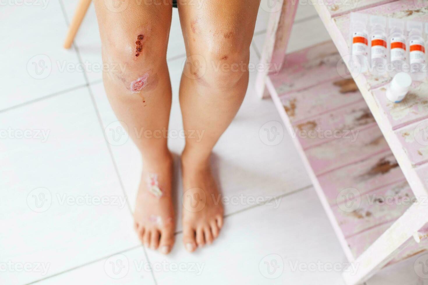 Woman taking care of injured knee photo