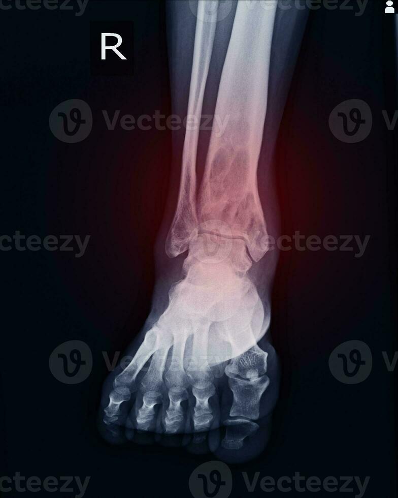 X-ray Rt.Ankle finding intramedullary osterolytic lesion of right distal tibia photo