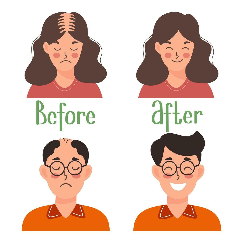 Human hair transplant. Woman and man before and after transplantation. Health care and medicine. Cartoon illustration, vector