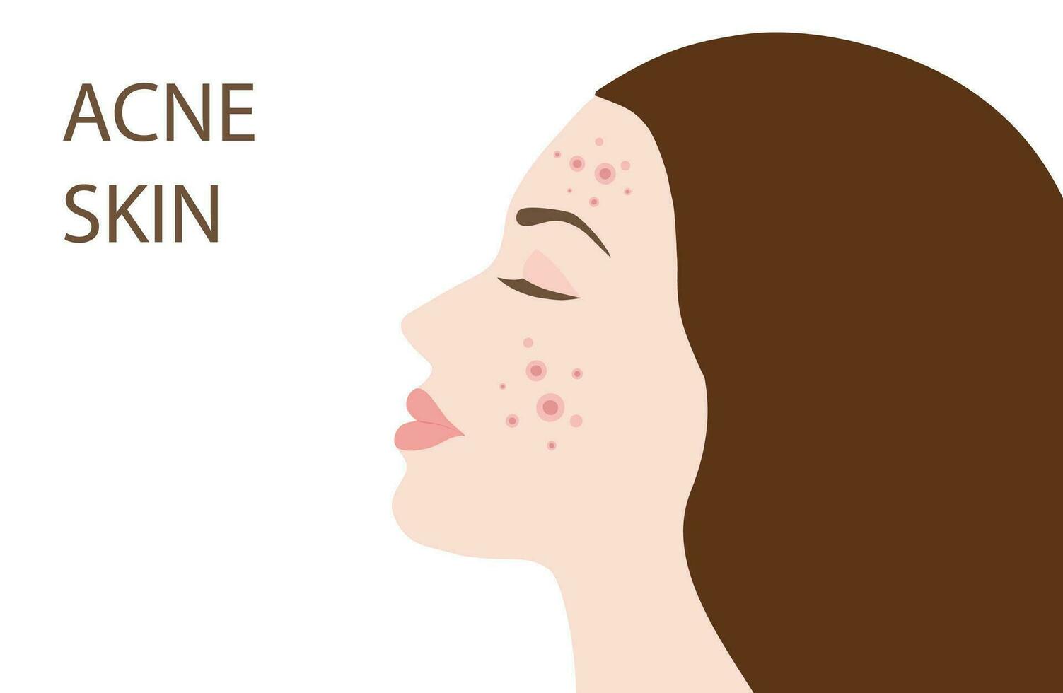 Young woman face with skin acne, pimples, blackheads vector illustration. Acne skin face problem concept