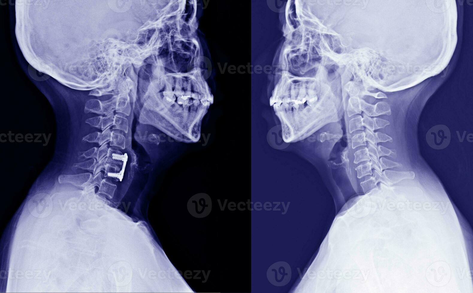 X-ray C-Spine Lateral normal views and Post operation spinal fixcation of C5-6 bodies Showing No spinal dislocation.Medical concept photo