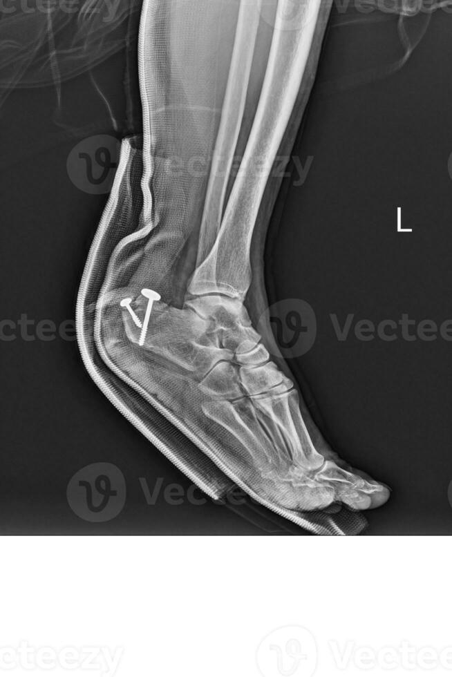 Film ankle X-ray radiograph showing heel bone broken close fracture calcaneus Medical technology and healthcare concept. photo