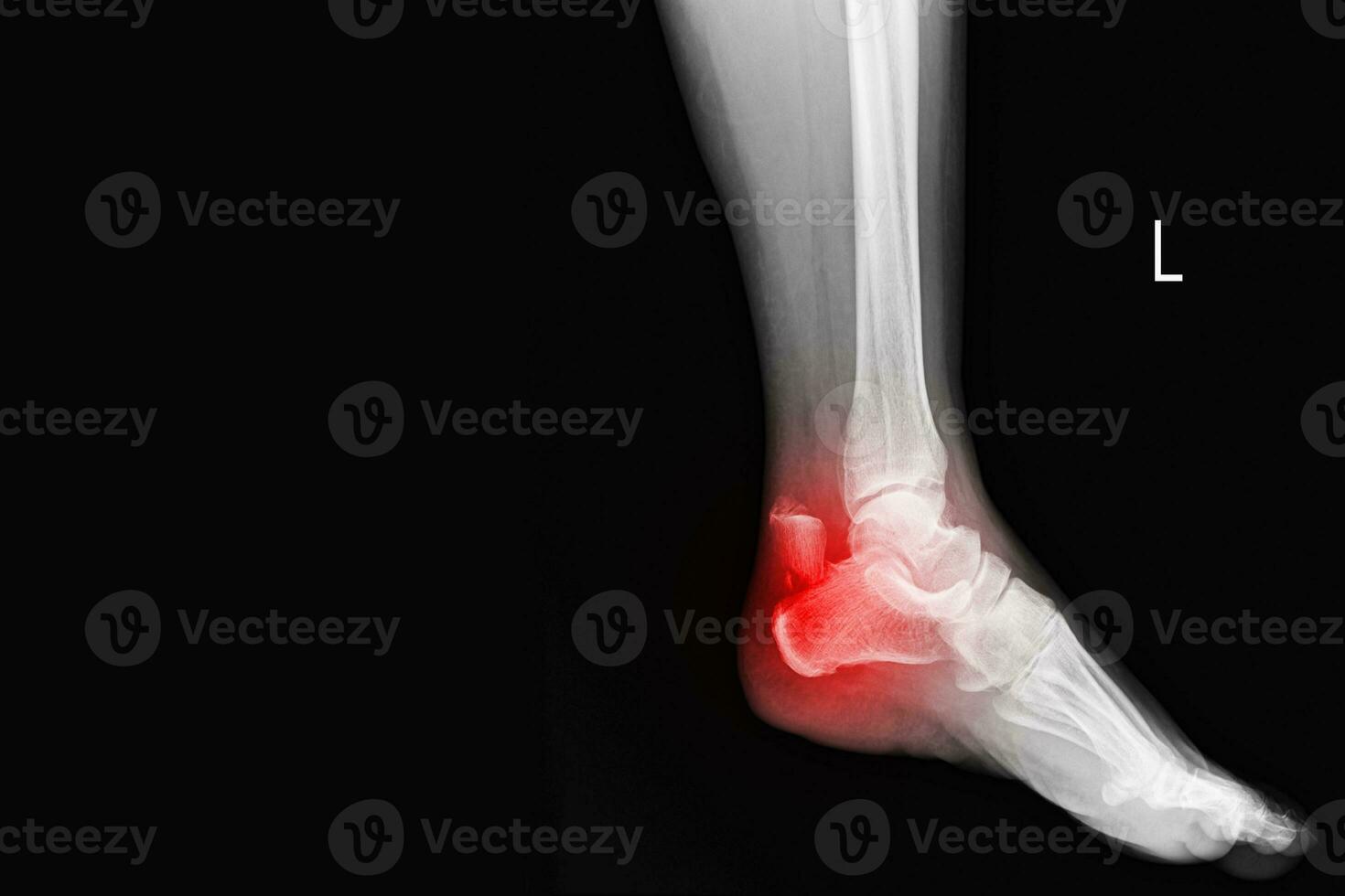 Film ankle X-ray radiograph showing heel bone broken close fracture calcaneus . Medical technology and healthcare concept. photo