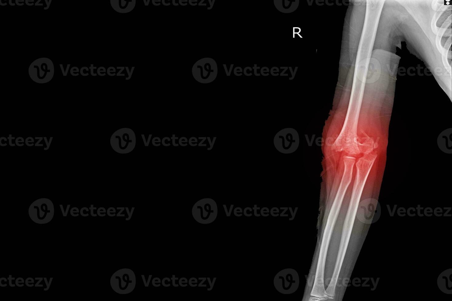 X-ray Elbow joint Finding Supracondylar fracture distal humerus with joint effusion.Medical image concept. photo