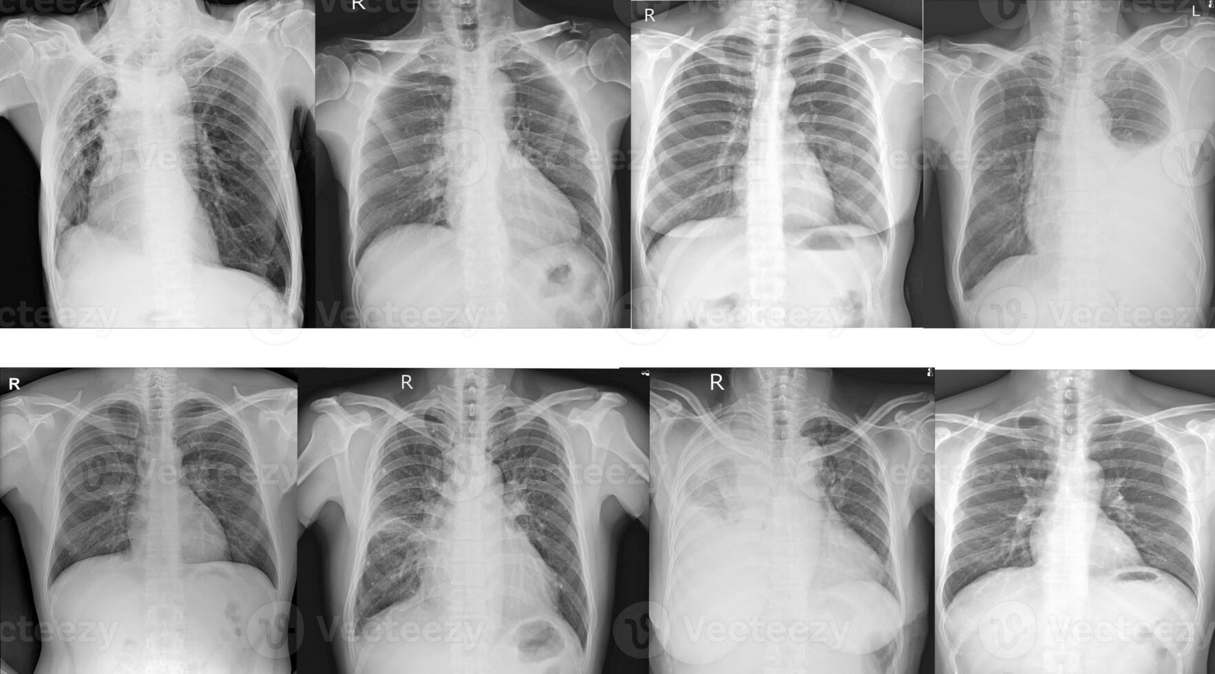 Collection chest x-ray for  doctors and medical professionals. To learn the disease.Healthcare concept. photo