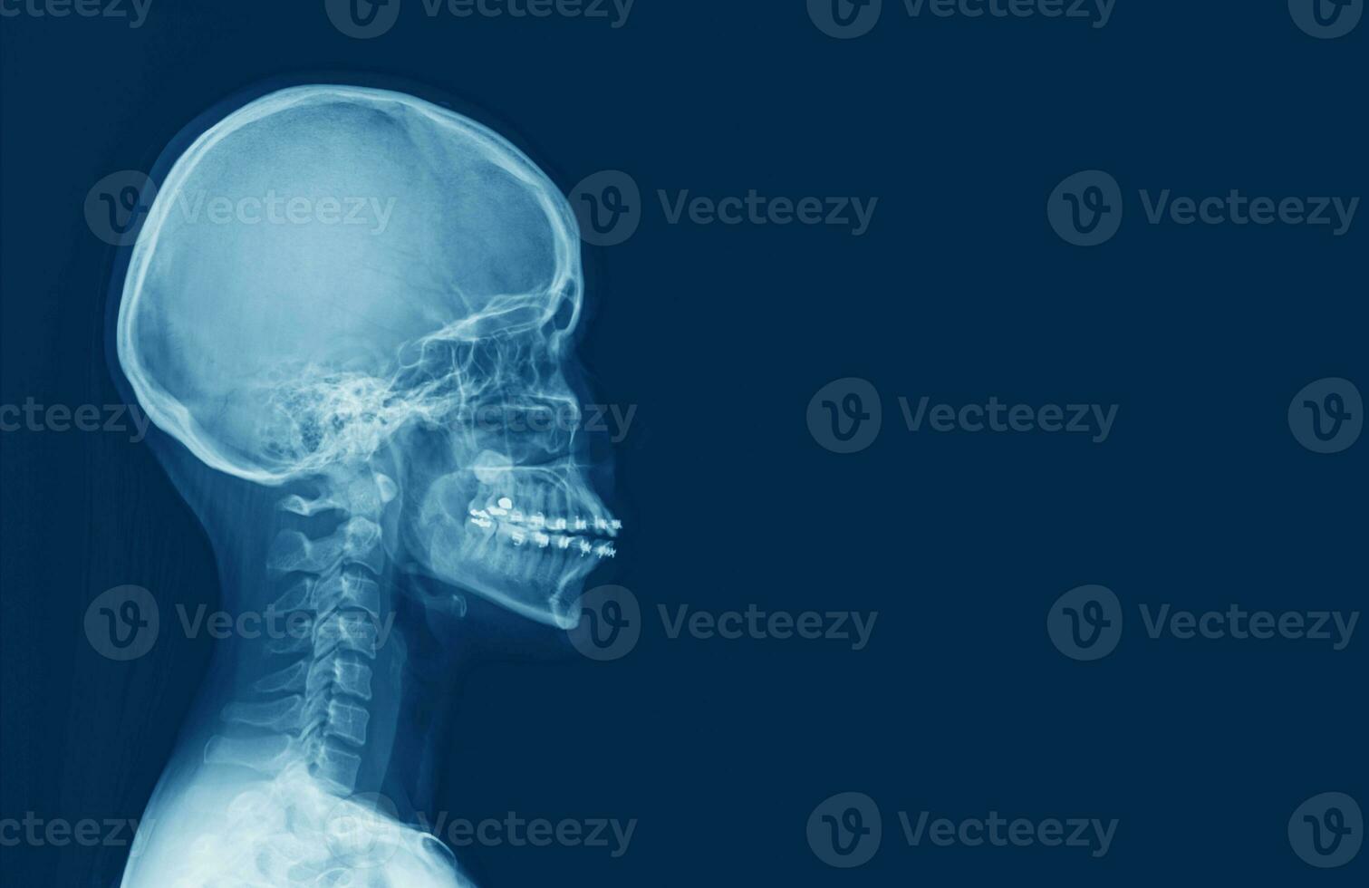 x-ray of human cervical spine and  head skull photo