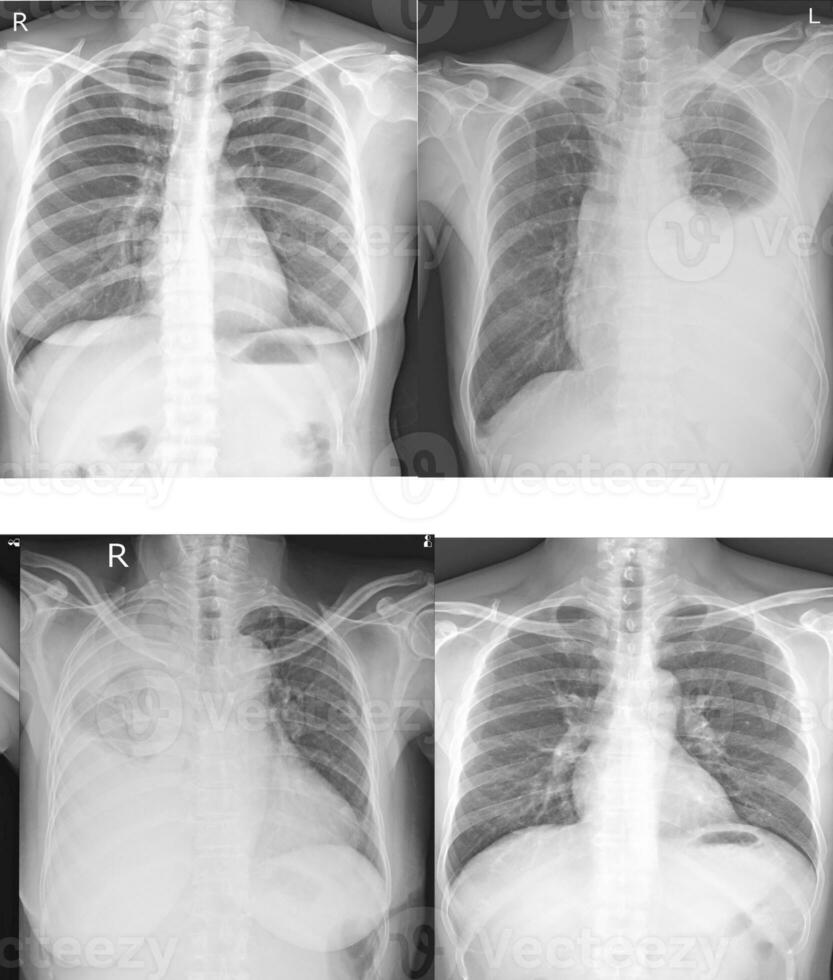 Collection chest x-ray for  doctors and medical professionals. To learn the disease.Healthcare concept. photo