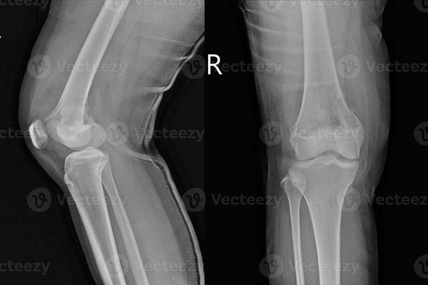 x-ray knee joint Views showing Osteosarcoma. photo