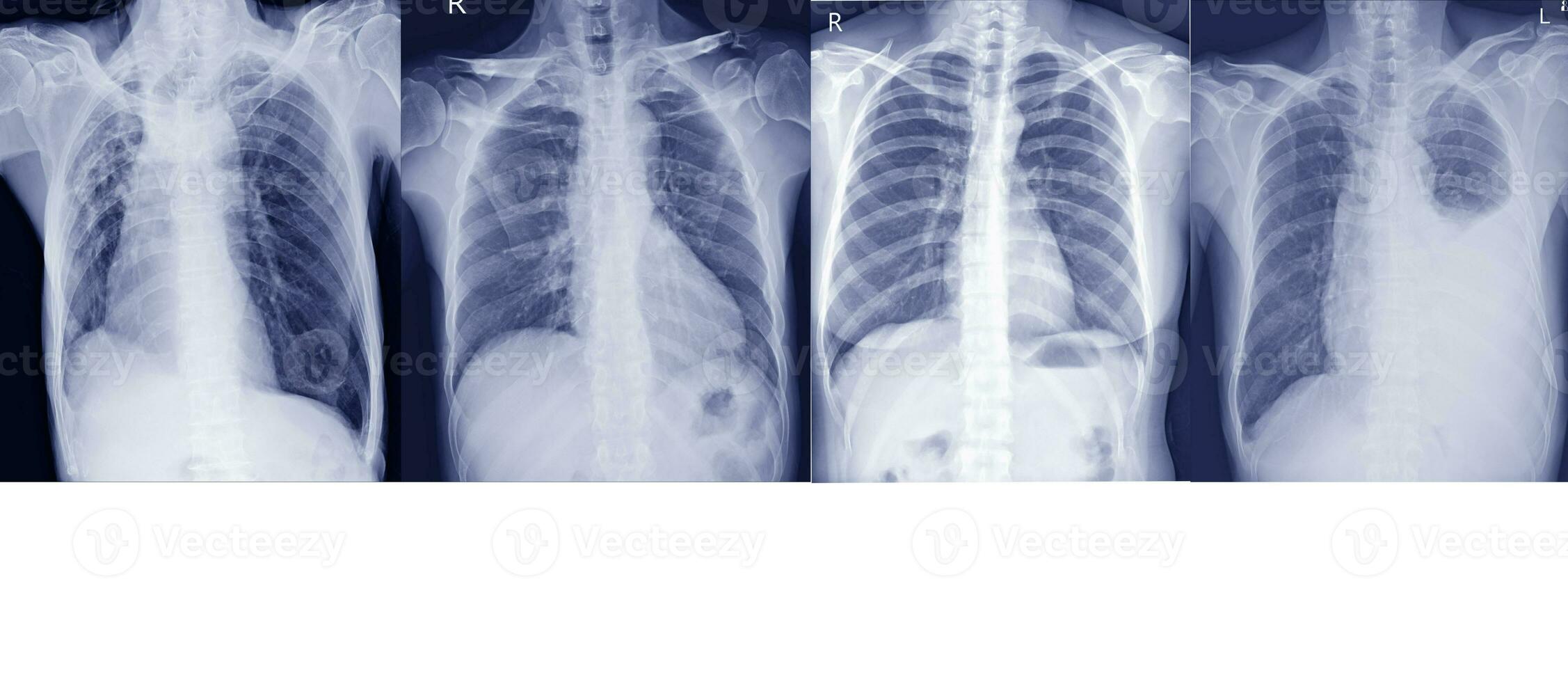 Collection chest x-ray for  doctors and medical professionals. To learn the disease.Healthcare concept. photo