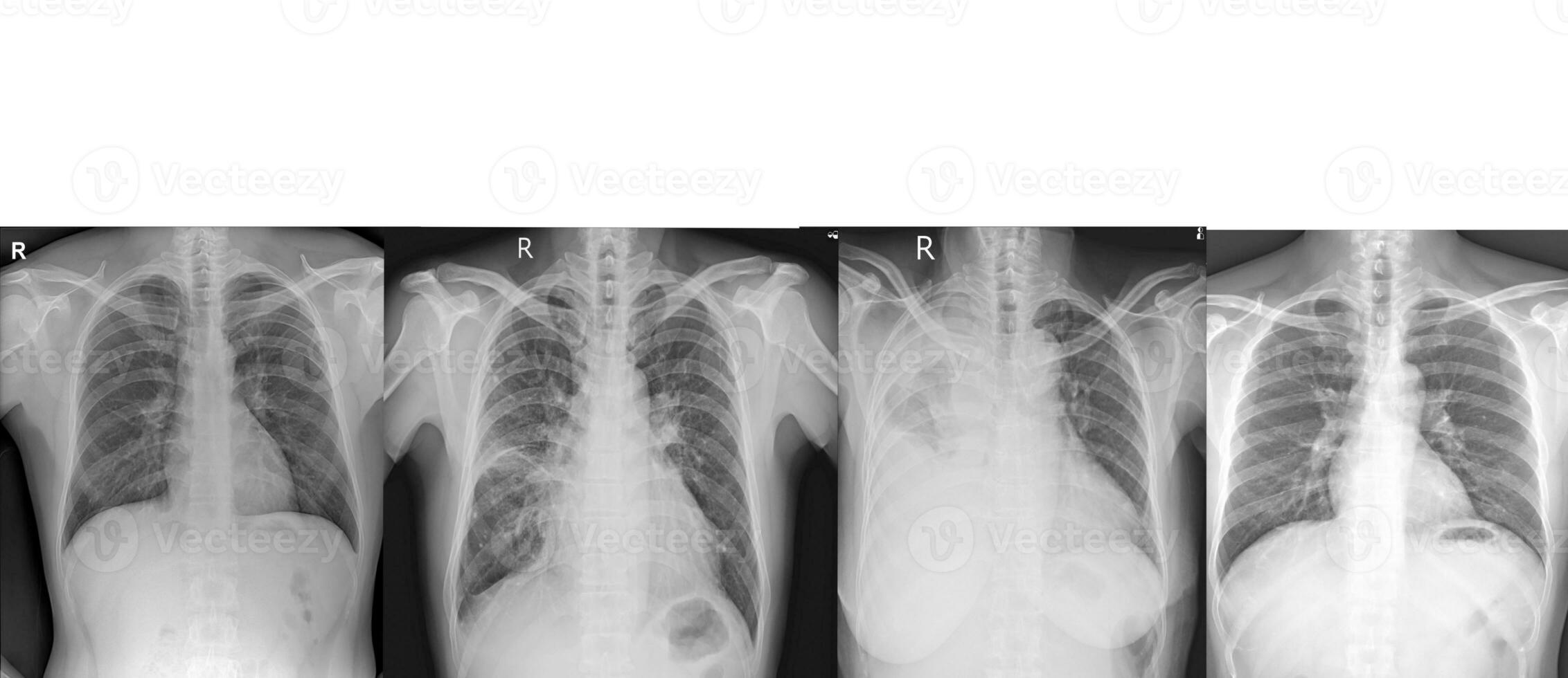 Collection chest x-ray for  doctors and medical professionals. To learn the disease.Healthcare concept. photo