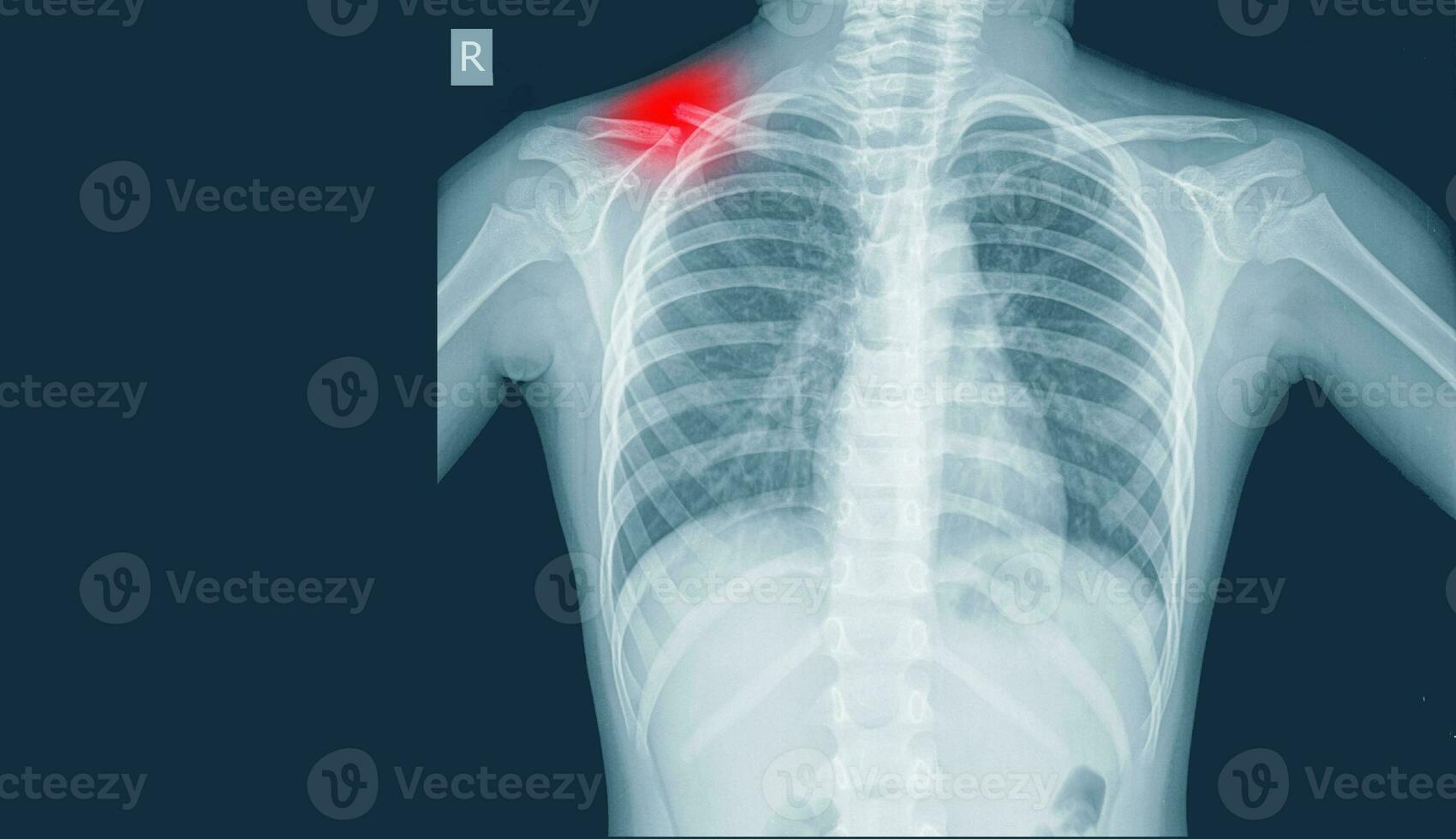 X-Ray Image Of Chest for a medical diagnosis views Showing fracture middle cavicle on red mark,Medical image concept. and coppy space. photo