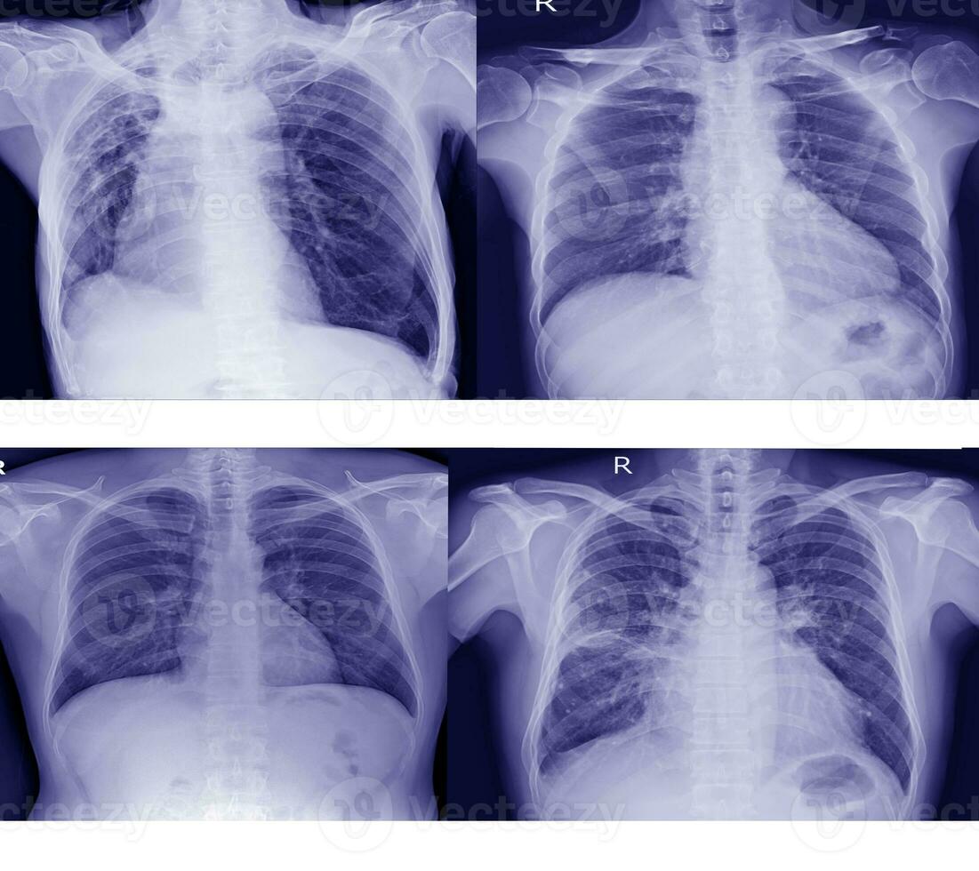 Collection chest x-ray for  doctors and medical professionals. To learn the disease.Healthcare concept. photo