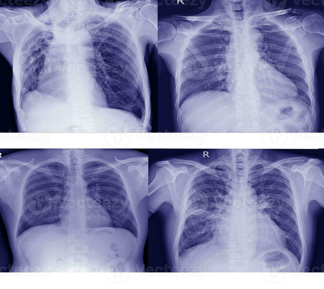 colección cofre radiografía para doctores y médico profesionales a aprender el enfermedad.cuidado de la salud concepto. foto