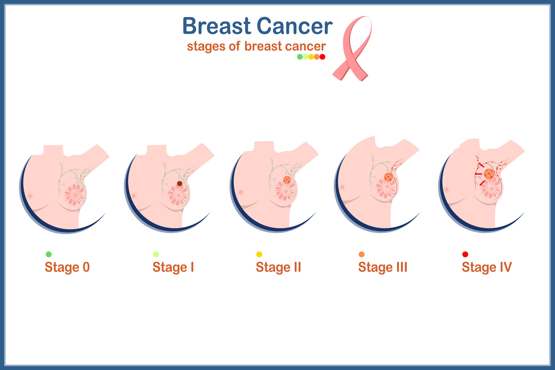 Medical illustration vector concept,female breasts and four levels