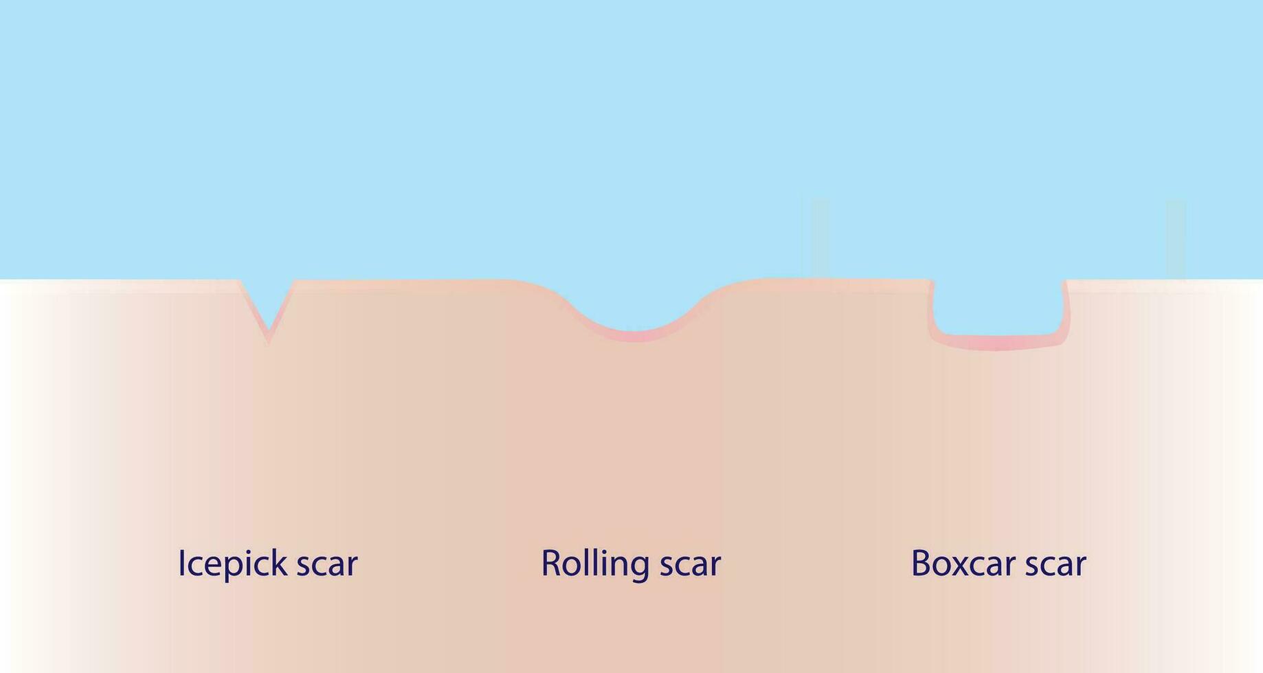 Types of acne scar vector on sky blue background. Icepick scar, rolling scar and boxcar scar with skin surface. Skin care and beauty concept illustration.