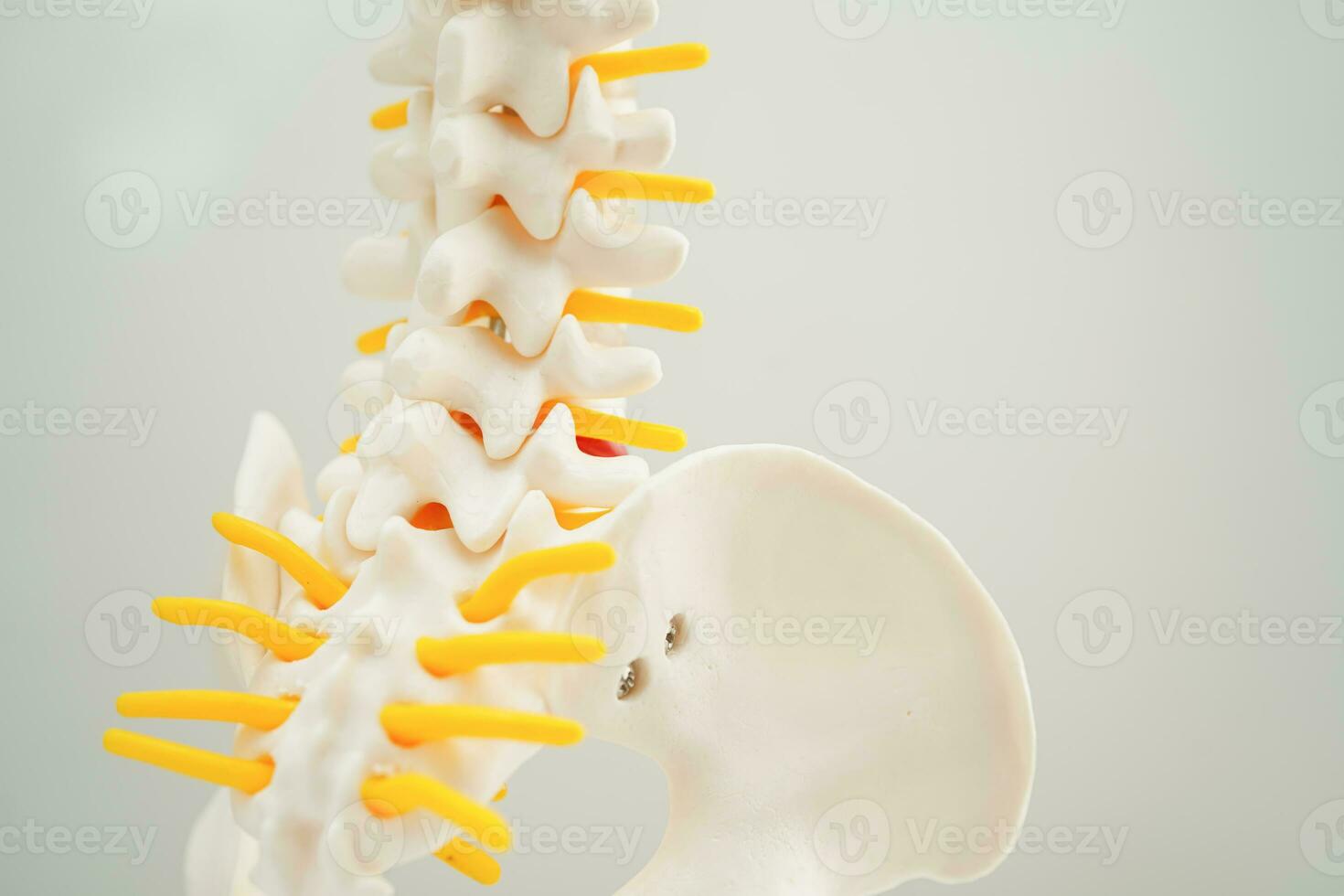 Spinal nerve and bone, Lumbar spine displaced herniated disc fragment, Model for treatment medical in the orthopedic department. photo